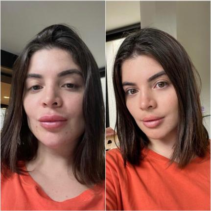 Influenciadora Gkay retira o preenchimento