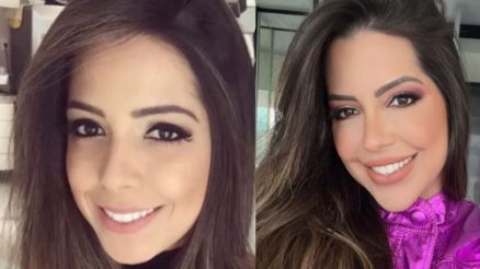 Laís Caldas mostra antes e depois dos procedimentos estéticos