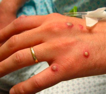 MT têm 6 municípios com casos suspeitos da ' Monkeypox'