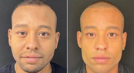 Mussunzinho faz harmonização facial e recebe elogio de Karoline